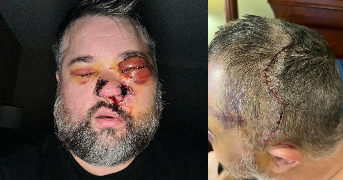 Gary Bitsicas After Hospital Release